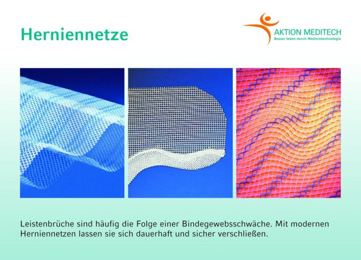 Leistenbrüche sind häufig die Folge einer Bindegewebsschwäche. Mit modernen Herniennetzen lassen sie sich dauerhaft und sicher verschließen.