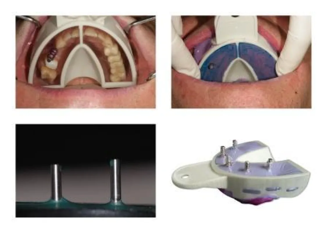 Vor, während und nach der Abformung mittels Miratray Implant