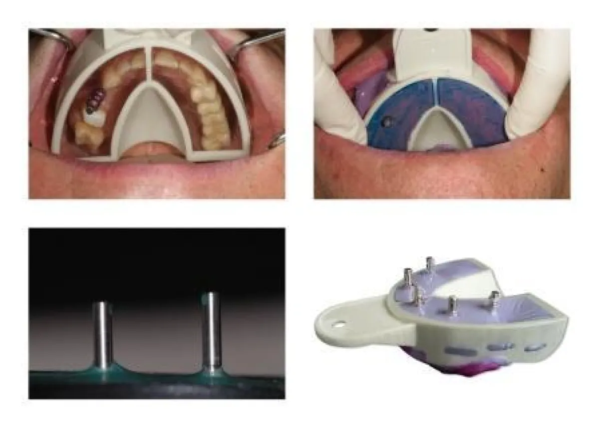 Vor, während und nach der Abformung mittels Miratray Implant