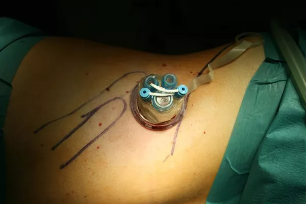 Bild: Doppelt minimal: Die Ein-Schnitt-Operation