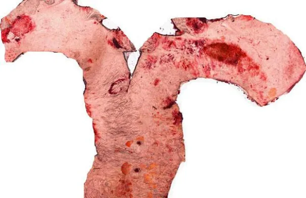 Bild: Folgeschäden bei Diabetes: entzündete Leber hebt Cholesterinspiegel