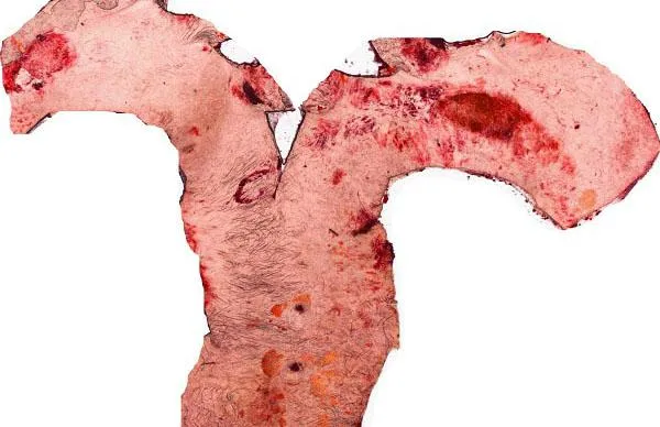 Bild: Folgeschäden bei Diabetes: entzündete Leber hebt Cholesterinspiegel