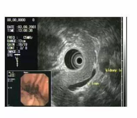 Bild: Hamburg gegen Darmkrebs - Neues Verfahren am Klinikum Eilbek