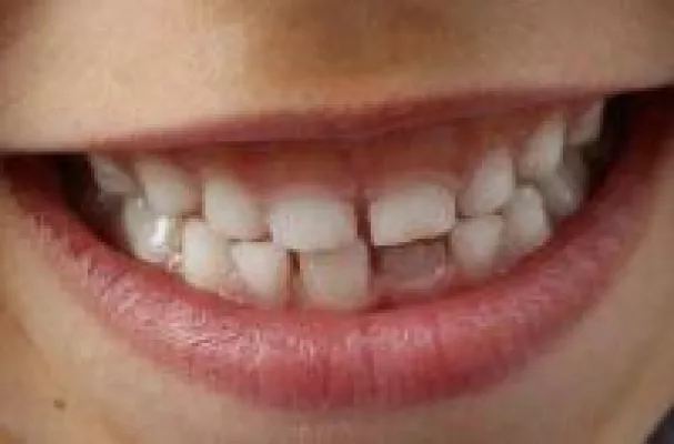 Bild: Zahnimplantate bei Kindern - wann  sinnvoll?