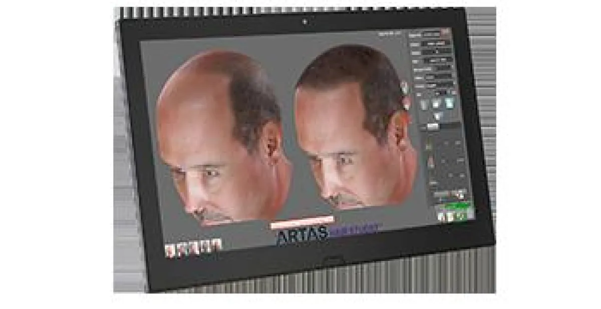 ARTAS Haartransplantation