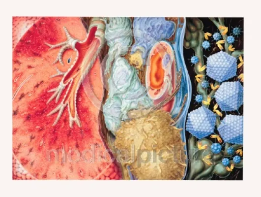 Bild: Lungenentzündung - Bedrohung für 800.000 Menschen