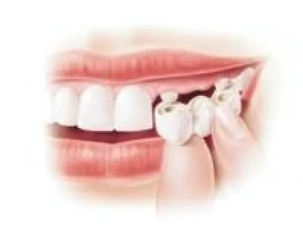 Bild: Probleme mit dem Zahnersatz