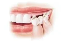 Bild: Probleme mit dem Zahnersatz