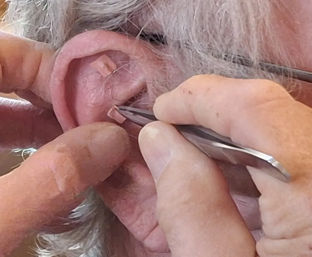 Samen mit hautfarbenem Pflaster über Punkten am Ohr können die Therapie unterstützen (© Eigenes Werk von Dr. Thomas Braun (Rötz, s.a. Pressekontakt))