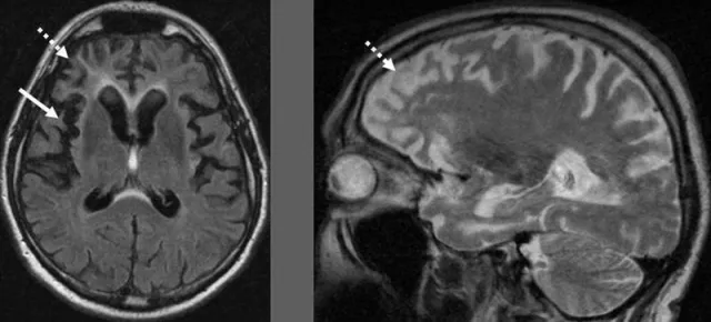 Bild: Frontotemporale Demenz: ein reiches Potpourri an Genen