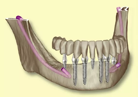 Einzelzahnversorgung: miniSKY ergänzt Implantatsystem von bredent Bild: Einzelzahnversorgung: miniSKY ergänzt Implantatsystem von bredent