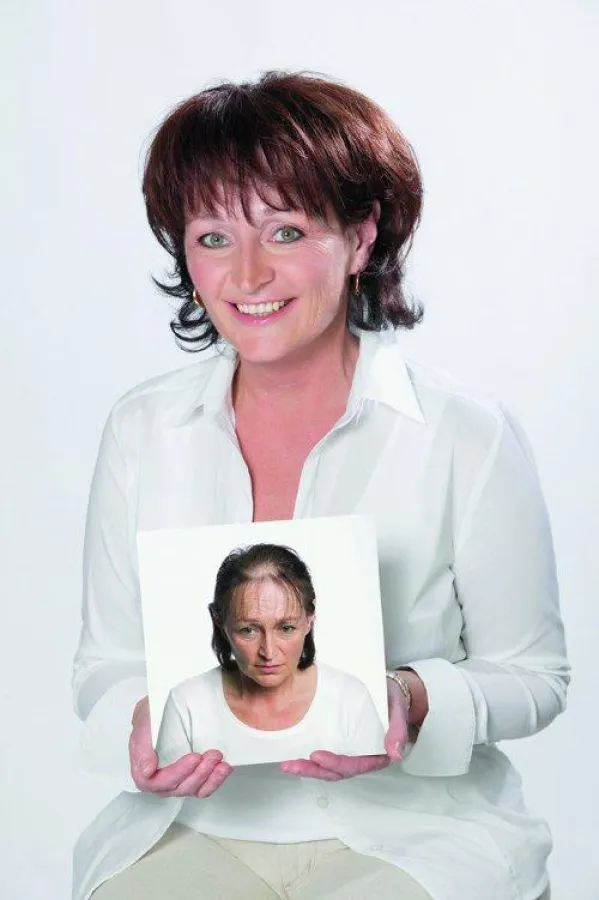 Vor und nach einer Haarverdichtung