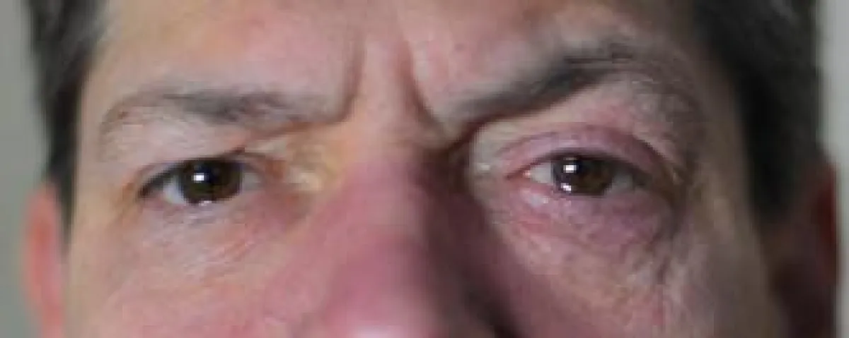 Akute Clusterattacke