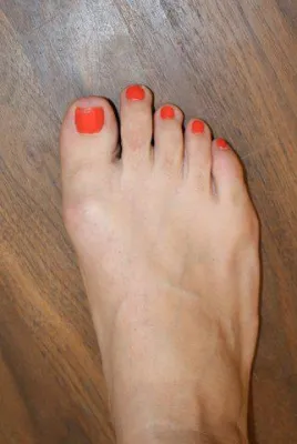 Bild: Zehenverkürzung- eine neue Chance für High-Heels und schöne Schuhe