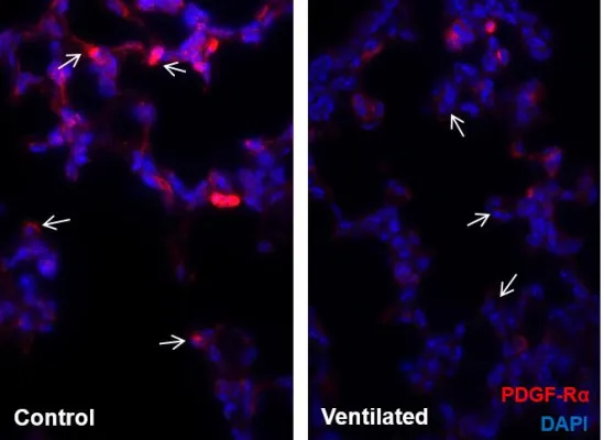Bild: Wie die Lunge frühgeborener Kinder Schaden nimmt
