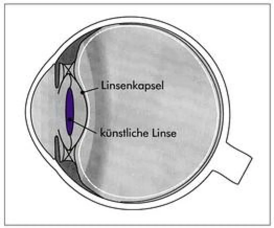 Zustand nach dem Eingriff