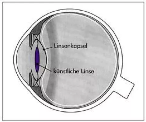 Grauer Star - was nun? Deutsche Gesundheitshilfe informiert Bild: Grauer Star - was nun? Deutsche Gesundheitshilfe informiert