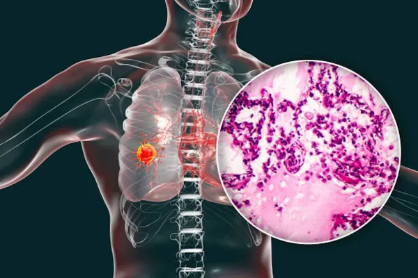 Bild: Lungenkrebs und das Immunsystem – neue Forschung stärkt die Hoffnung auf personalisierte Immuntherapien