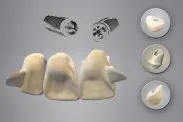 Bild: CAD/CAM Implantat-Provisorium als Flügelbrücke im Frontzahnbereich