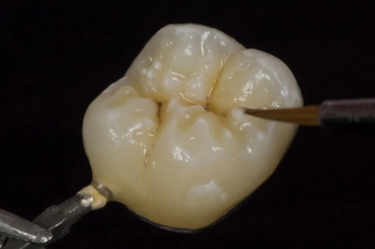 Jensen Dental schließt mit InSync MC Lücke bei den 