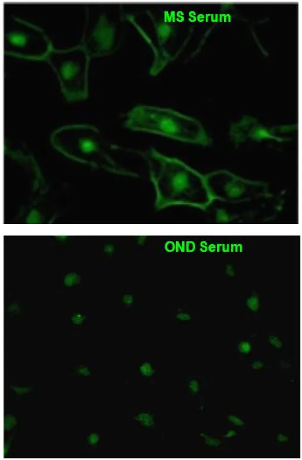 Im MS-Serum ist die Bindung des Autoantikörpers an die Zellmembran der Gliazellen gut erkennbar.