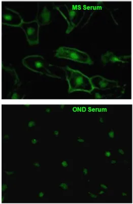 Bild: Multiple Sklerose: Neuer Marker könnte Diagnose erleichtern