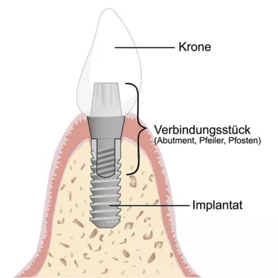 Bild: Kaputter Zahn raus, gleich danach neues Implantat einsetzen. Geht das so schnell?