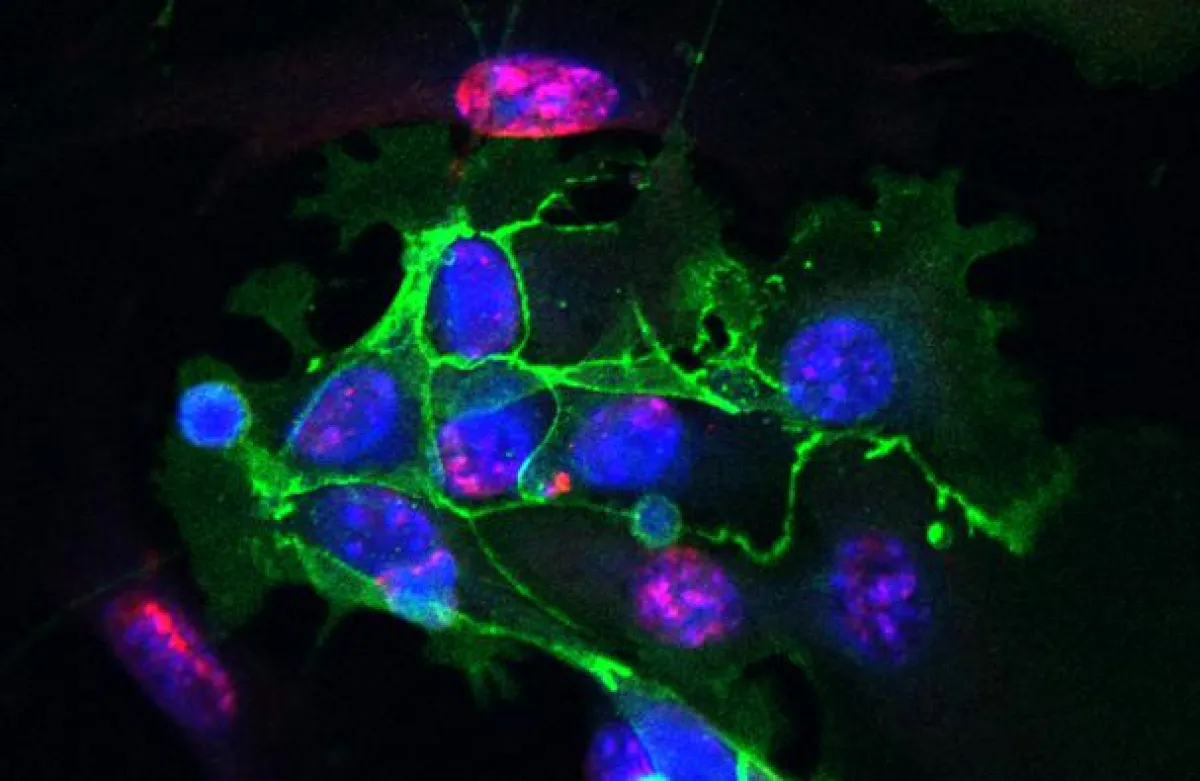 Sample of lung fibrosis: Green cells show markers of the lung epithelium, red cells are undergoing senescence. The nuclei are stained in blue. (Source: Helmholtz Zentrum München)