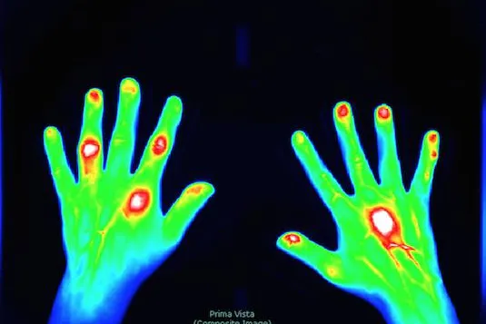 Bild: Rheuma-Früherkennung leicht gemacht: Xiralite macht Entzündungen in den Händen sichtbar