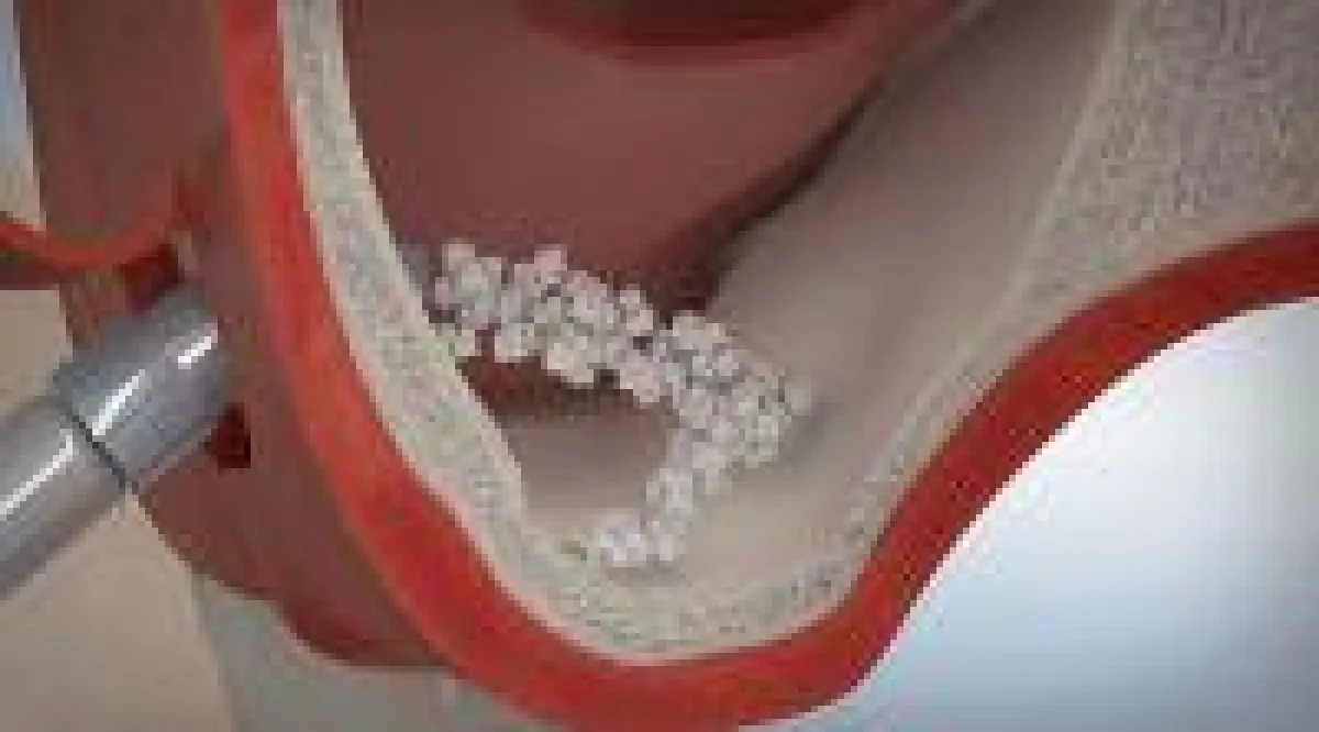 Prof. Dhom Sinuslift