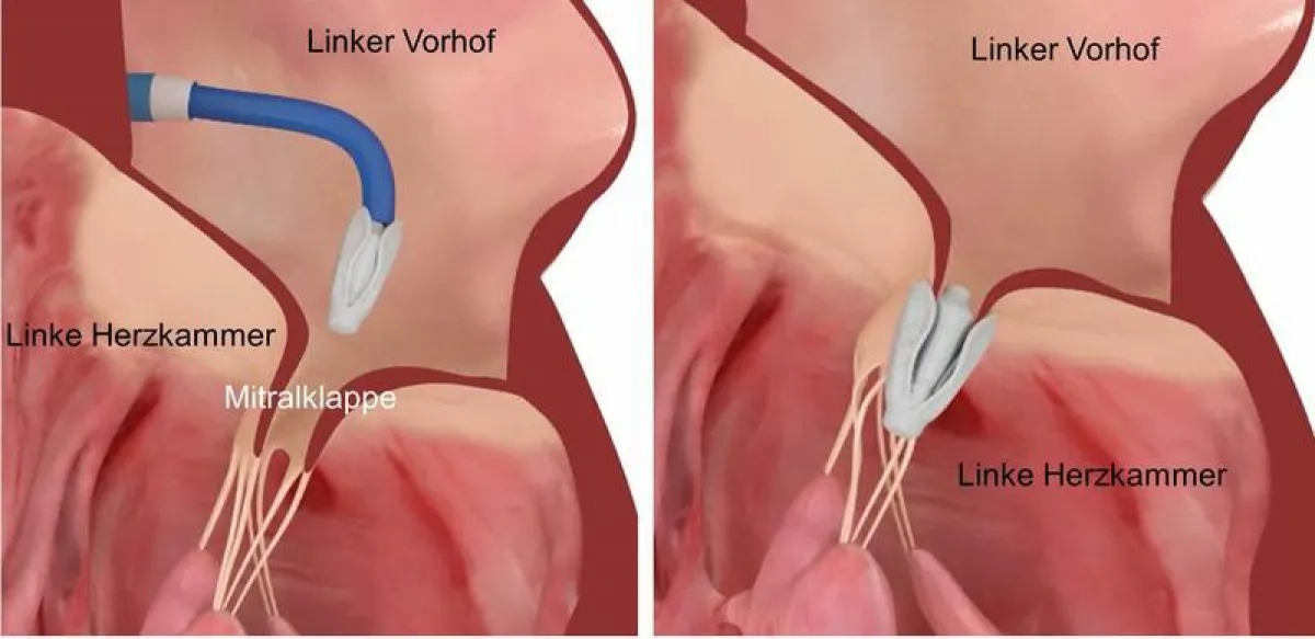 Starting from an inguinal vessel, the newly developed implant is introduced into the left atrium of the heart and placed at the site of the mitral valve leakage.  (Inselspital, Bern University Hospita