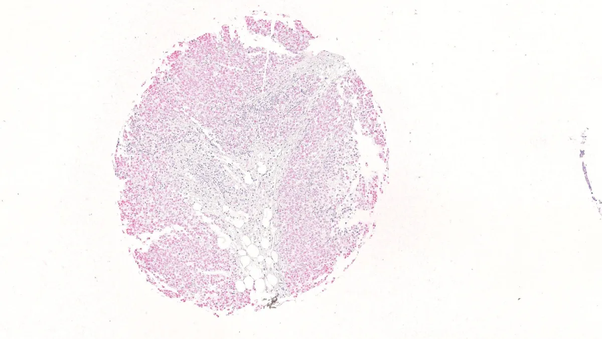 Immunhistochemische Detektion von PRC1 in Ewing-Sarkomgewebe (© Grünewald/DKFZ)