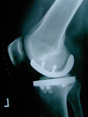 Bild: 2. Arthrosetag am Maingau Krankenhaus Frankfurt