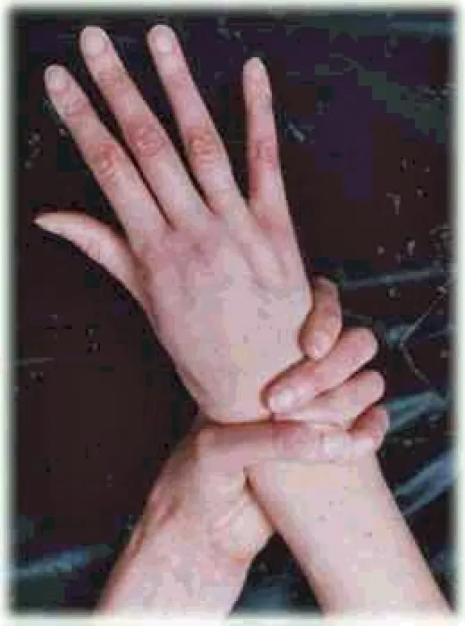 Handzeichen Marfan-Syndrom