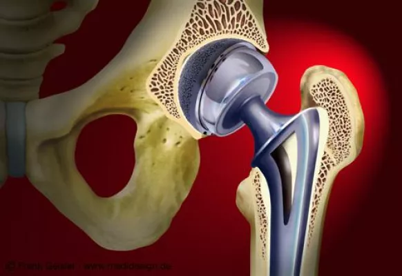 Bild: Orthopädische Arbeitsgemeinschaft für medizinische Illustration und anatomische Grafik