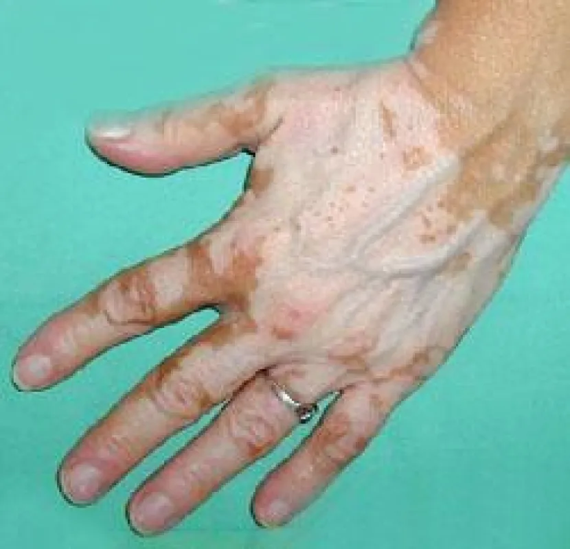 Heilbar- Vitiligo