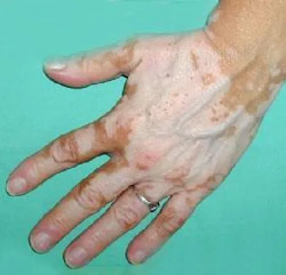 Bild: Vitiligo – Da kann man nichts tun….?