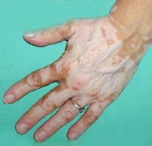 Bild: Vitiligo – Da kann man nichts tun….?
