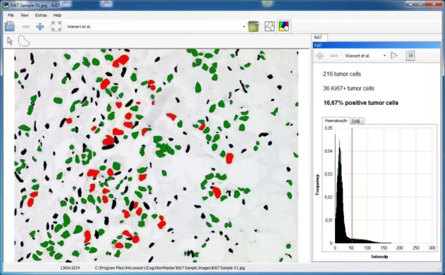 Bild: VMscope und Pixcelldata bieten online Digitale Pathologie Lösung mit automatisierter Ki67 Quantifizierung