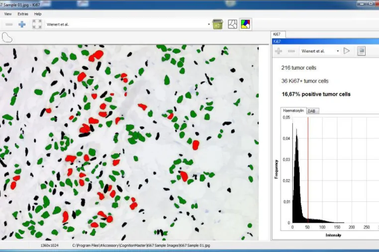 Bild: VMscope und Pixcelldata bieten online Digitale Pathologie Lösung mit automatisierter Ki67 Quantifizierung
