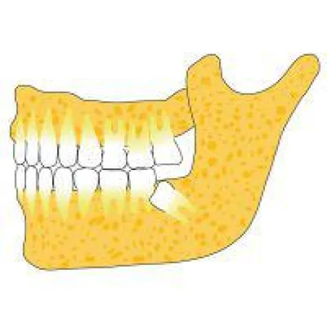Bild: Weisheitszähne entfernen - Wann, Warum und Wie?