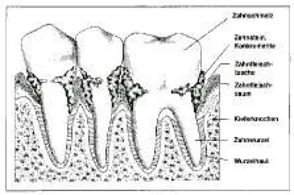 Bild: Parodontose - die unterschätzte Gefahr - Deutsche Gesundheitshilfe informiert