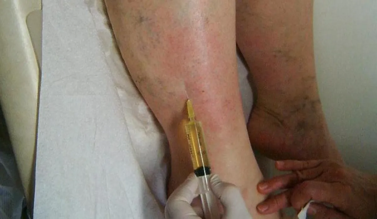 Eine gering dosierte Mischung hoch wirksamer Substanzen gelangt mittels Mikroinjektionen über die Haut direkt zu den erkrankten Venen