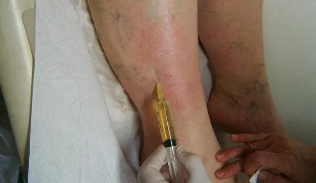 Bild: Wenn die Venen Feuer fangen