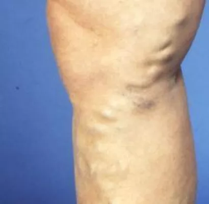 Schaumverödung – die neue Waffe gegen Krampfadern Bild: Schaumverödung – die neue Waffe gegen Krampfadern