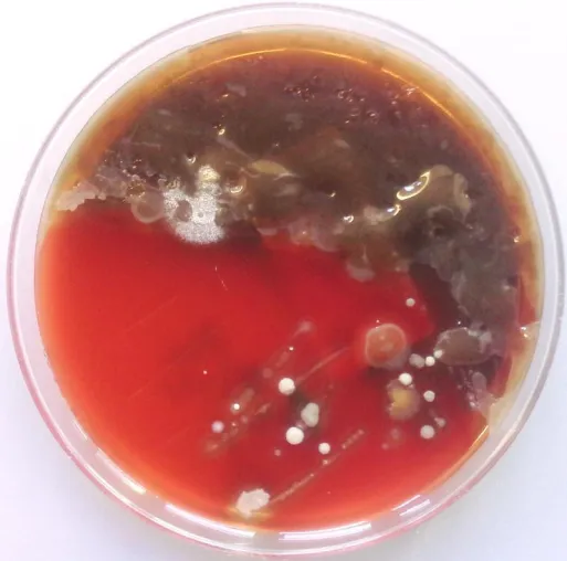 Bild: Cystische Fibrose: chronische Infektionen mit Lungenkeim verhindern