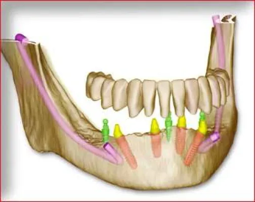 Bild: SKYplanX 3D - Implantatplanung: Maximale Sicherheit für maximale Wertschöpfung