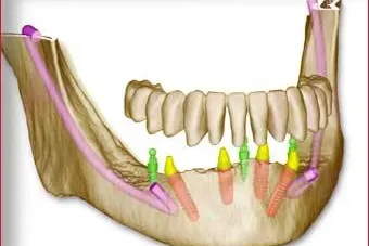 SKYplanX 3D - Implantatplanung: Maximale Sicherheit für maximale Wertschöpfung Bild: SKYplanX 3D - Implantatplanung: Maximale Sicherheit für maximale Wertschöpfung
