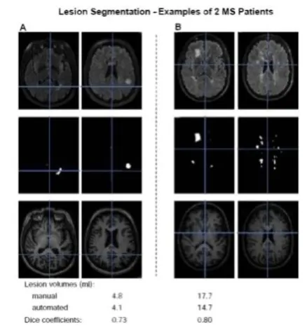 Bild: MS-Forschung: Läsionen schnell und effizient aufspüren