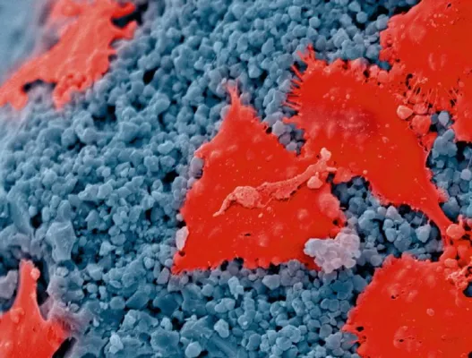 Knochenersatzmaterial in der Zahnmedizin: bredent ergänzt Produkte rund um Implantate Bild: Knochenersatzmaterial in der Zahnmedizin: bredent ergänzt Produkte rund um Implantate